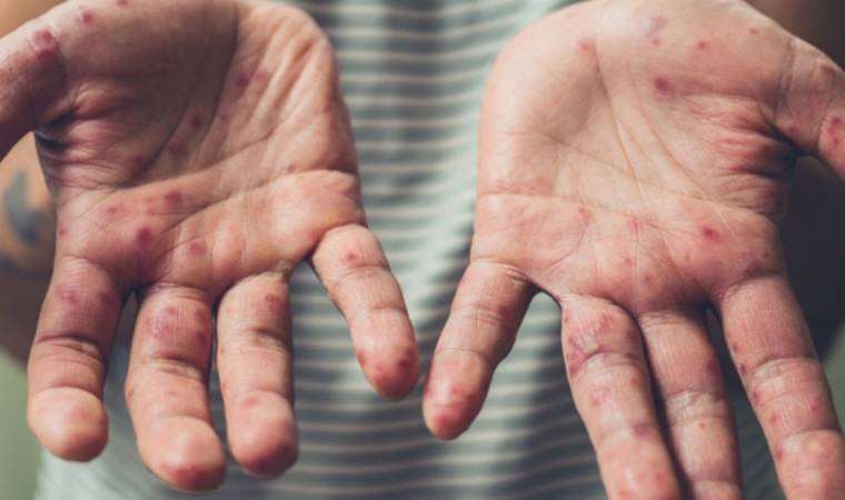 Kızamıkta 'kış' endişesi