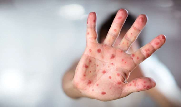 Uzmanından 'kızamık virüsü' hakkında uyarılar