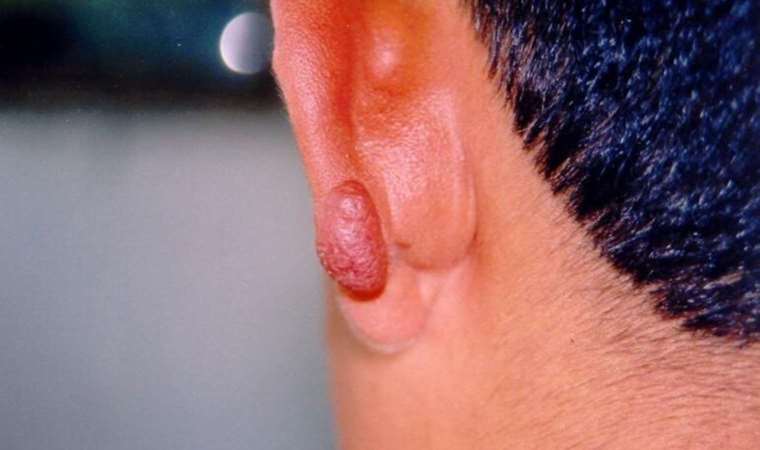 Kum sineği ısırmasına dikkat edin: Dalakta ve karaciğerde büyümeye neden oluyor