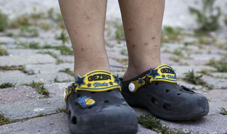 Sivrisinek yaraları nedeniyle hastanelere başvurular artıyor: ‘Isırmıyorlar, resmen koparıyorlar’