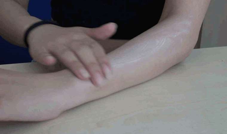 Uzmanı uyardı: Güneş yanıklarına evde tedavi uygulanmamalı