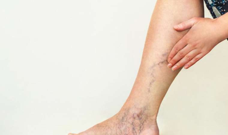 Sıcak havalar varis hastalığını tetikliyor