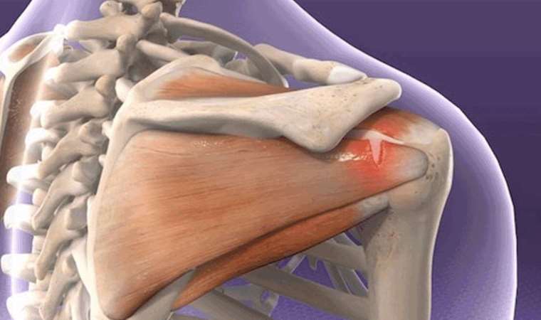 Tedavi edilmeyen omuz yırtıkları dikkate alınmalı