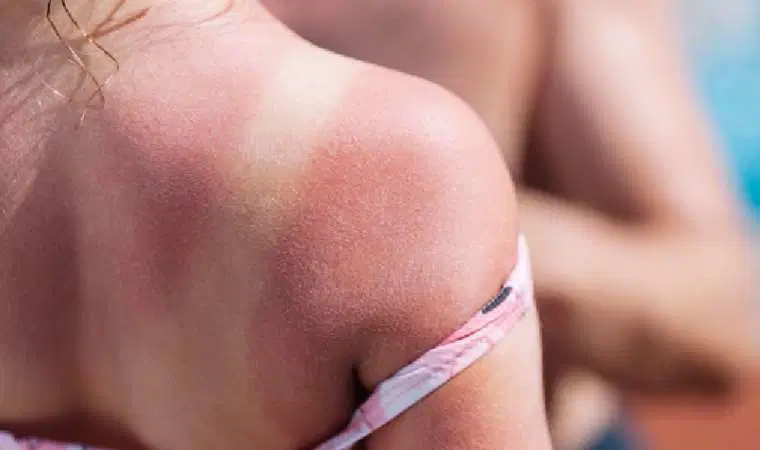 Deniz kum güneşin tehlikeli yanı: Güneş yanığı