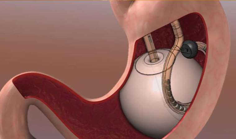 Tüp mide ameliyatı olanlar dikkat: Sıvı alımının önemi