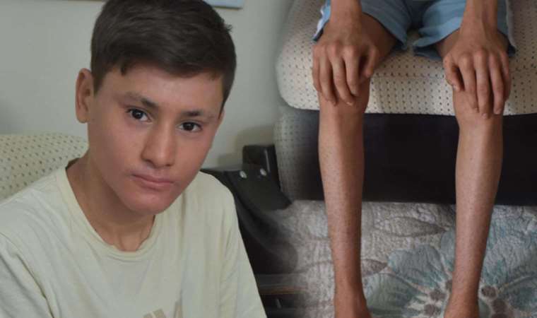 Hastalığı yüzünden gündüzleri evden çıkamıyor: 'Balık pulu' hastası Kayra'nın bakım parası kesildi