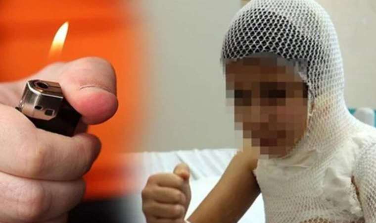 Videodan etkilenerek kolonyayla kendini yakmıştı: 9 yaşındaki çocuk ameliyat edildi