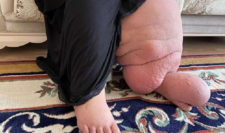 Fil Hastalığı (lenfödem) tedavisi nedir?