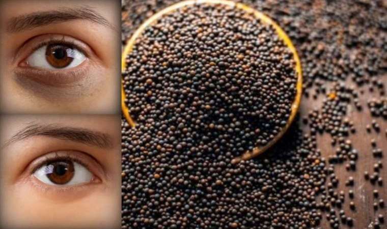 1 çay kaşığı kullanarak göz altı morluklarından sonsuza kadar kurtulmak mümkün