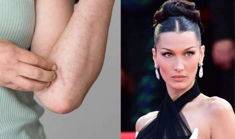 Lyme hastalığı nedir? Bella Hadid'in hastalığı Lyme'nin belirtileri nedir? Lyme hastalığının tedavisi var mı?