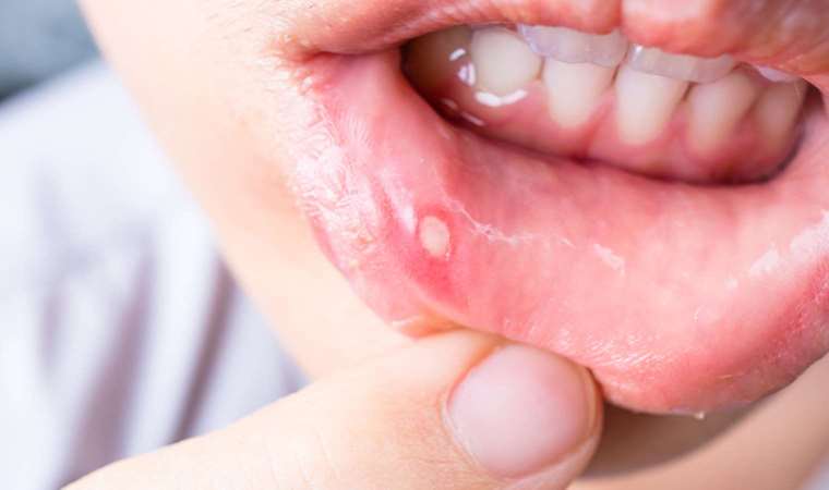 Gününüz aft yaralarından zehir olmasın: Ağız yaralarını 1 saatte geçirin
