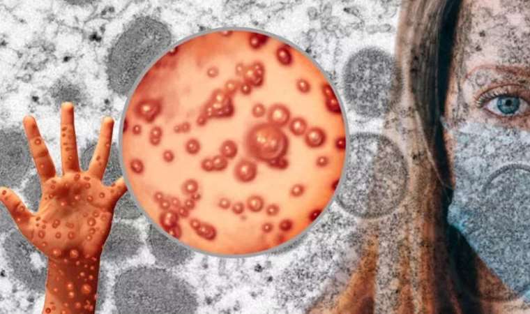 Maymun çiçeği, Covid-19, AIDS ve kuş gribi ile aynı sınıfa koyuldu