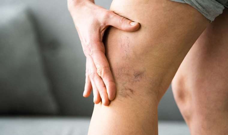 Varise karşı evde uygulayabileceğiniz yöntem: 1 bardağı yeterli oluyor... Hepsini yok edin