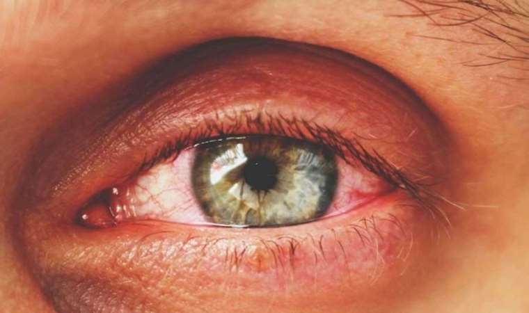 'Kırmızı göz' salgını yayıldı: 86 bin kişi şikâyetçi