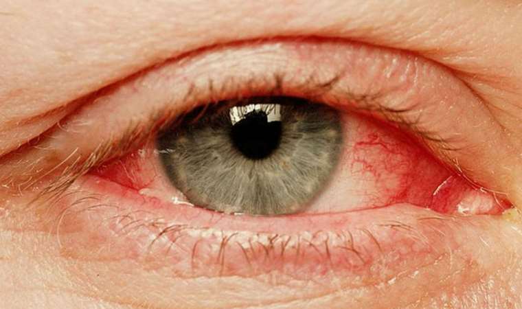 Pakistan'da 'kırmızı göz' hastalığı alarmı: Vaka sayısı 86 bini geçti