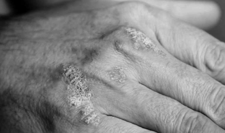 Uzmanından kronik 'ürtiker' hastalarına beslenme uyarısı