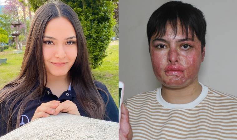 'İş kazası'nda vücudunun yüzde 80'i yanan Beyzanur: Eski ben değilim artık