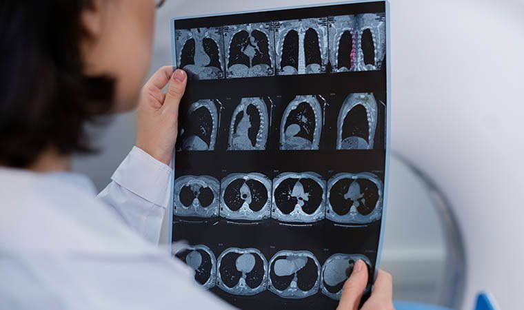 Uzmanından uyarı: 'Kan sulandırıcı kullanımı beyin kanaması riskini artırabilir'