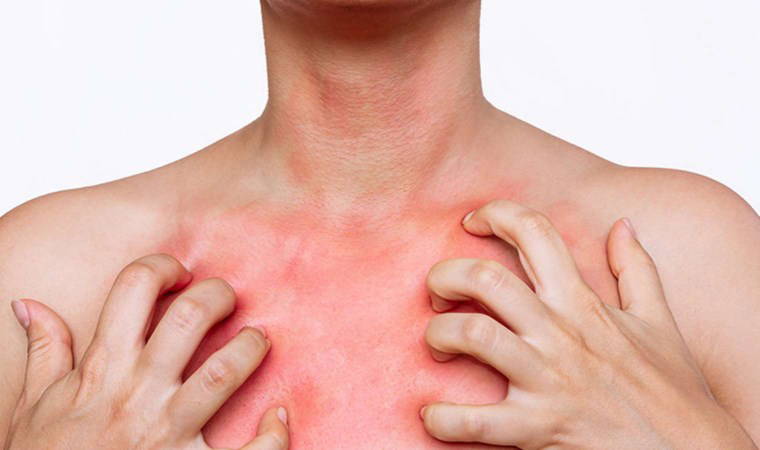 Dermatoloji uzmanları açıkladı: 'Uyuz hastalığının tedavisi kolaylaştı'