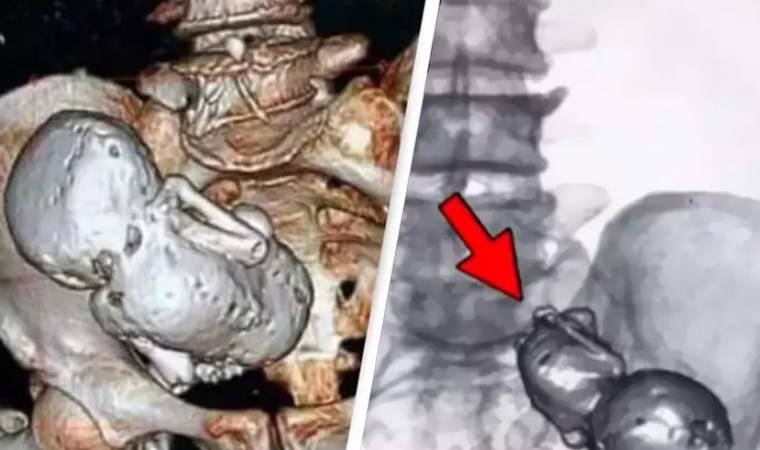 Tıp tarihinde bir mucize...