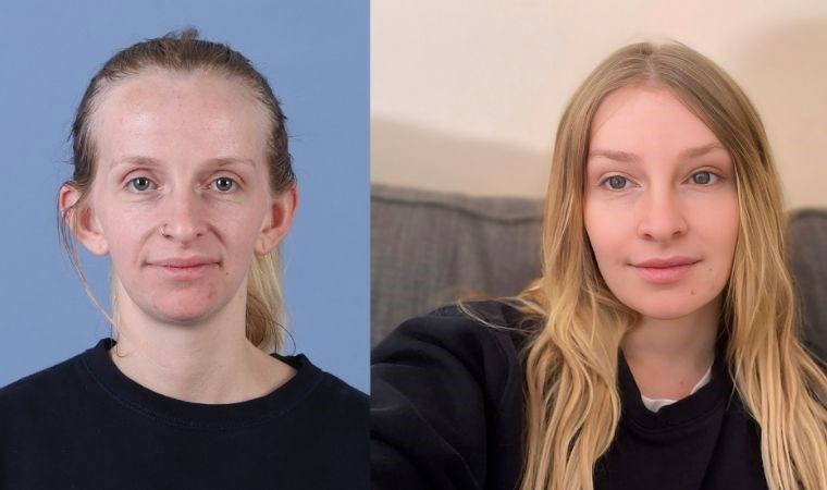 Dr. Cengizhan Ekizceli, Avustralyalı turistin hayalini aynı anda 11 estetik işlemle gerçeğe dönüştürdü