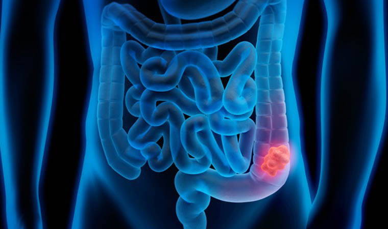 ‘Kalın bağırsak kanserini yüzde 90 oranında önlemek mümkün’
