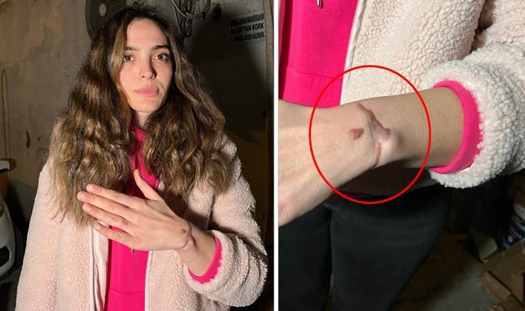 'Kolumu yaktılar, dokuları ölmüş...'
