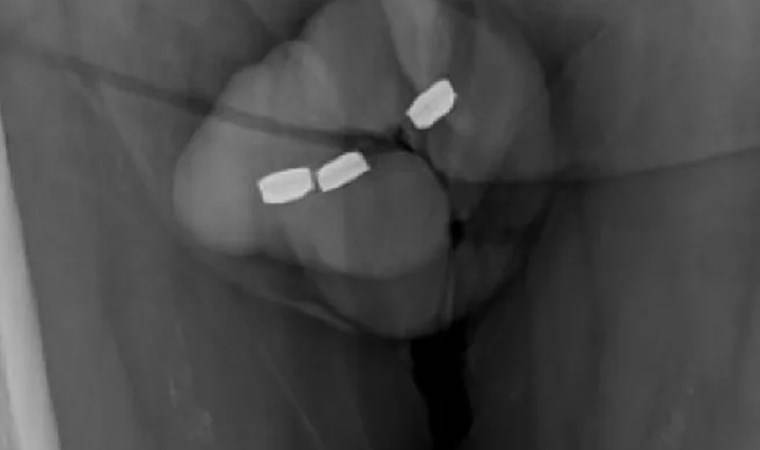 'Cinsel tatmin' için penisine pil soktu...