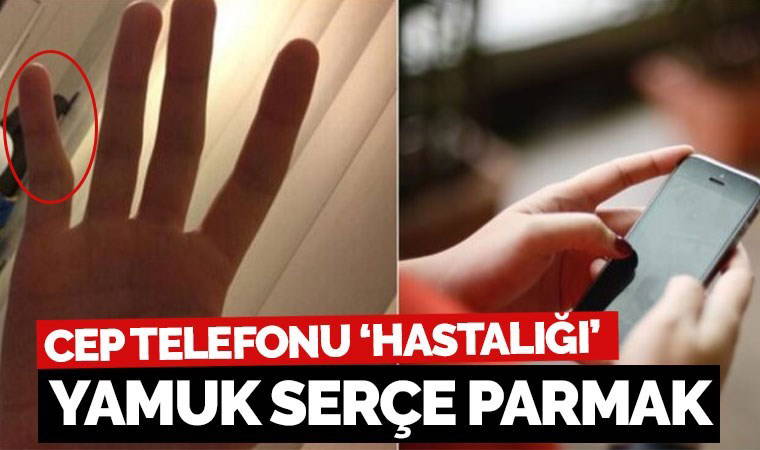 Cep telefonu kullananlara 'yamuk serçe parmak' uyarısı: Cerrahi müdahale gerektirebilir!