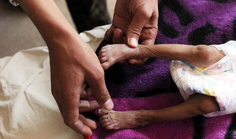 29 Şubat Dünya Nadir Hastalıklar Günü! Dünya Nadir Hastalıklar Günü nedir, nasıl ortaya çıktı?