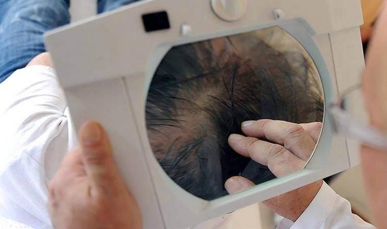 'Saç ekimi' davasında emsal karar: Mahkeme ayıplı işlem olarak kabul etti; ücret iadesine karar verdi