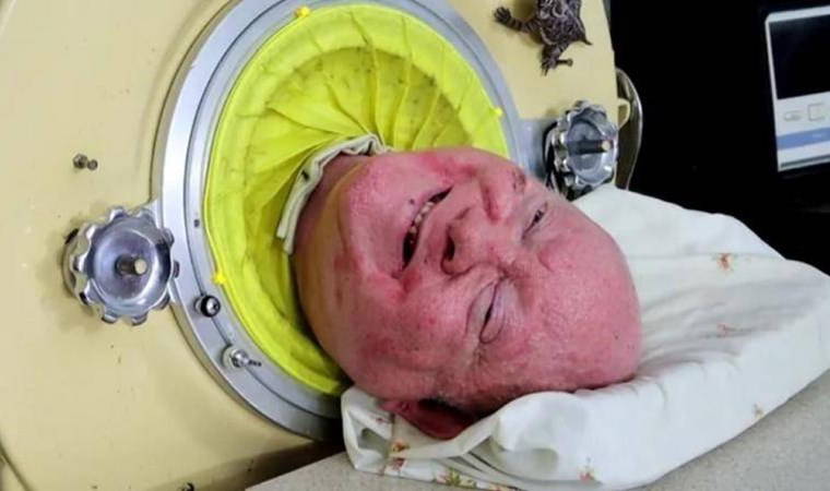 'Demir akciğerli adam' 78 yaşında hayatını kaybetti