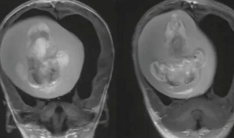 Doktorlar şaşkına döndü: Bebeğin beyninden ikizi çıkarıldı