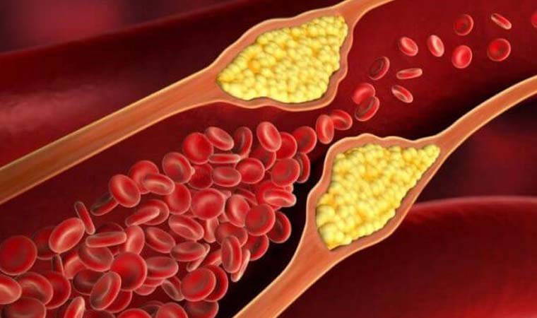 Uzmanı uyardı: Kolesterol ne zaman tehlikeli olur?