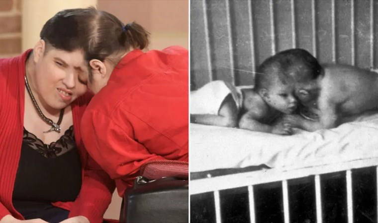 Dünyanın 'en yaşlı' yapışık ikizleri hayatını kaybetti