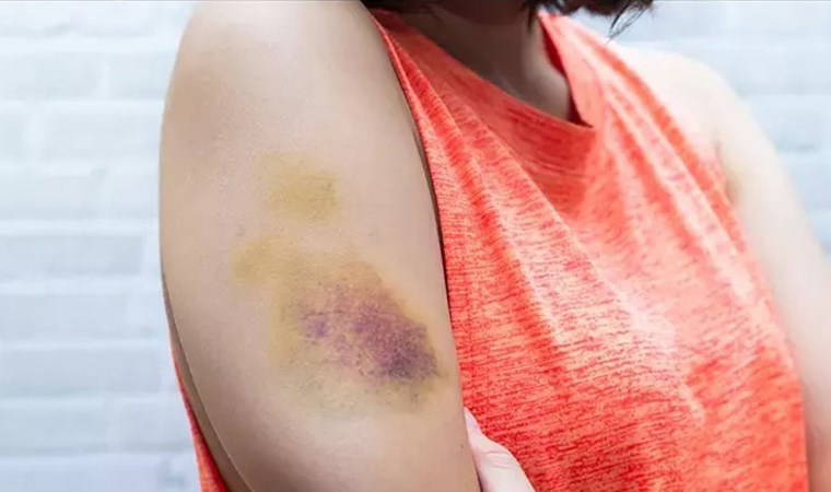 Bu belirtiler hemofili habercisi olabilir