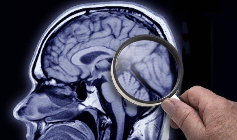 Demans ve Alzheimer: Belirtileri nedir, hangi tedaviler uygulanıyor?