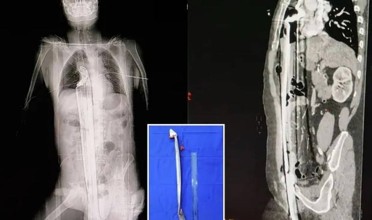 91 cm uzunluğunda demir çubuk çıkarıldı...