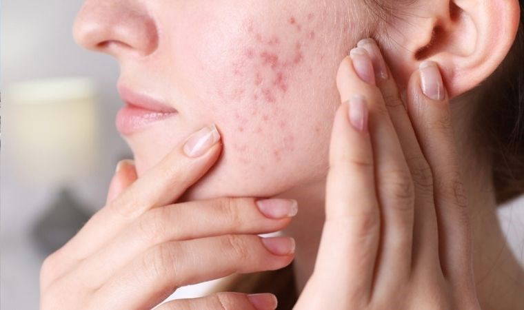 Cilt sorunları psikolojiyi bozuyor! Akneler mental sağlığı etkiliyor