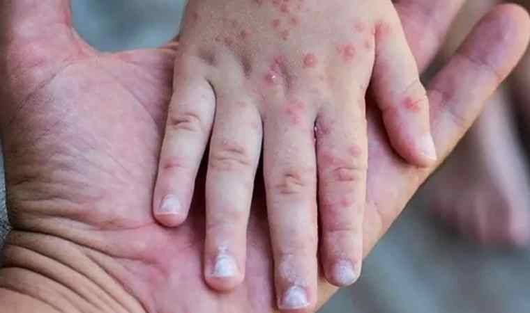 Çiçek aşısı koruyor mu?