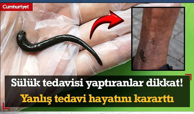 Sülük tedavisi yaptıranlar dikkat! Yanlış tedavi hayatını kararttı