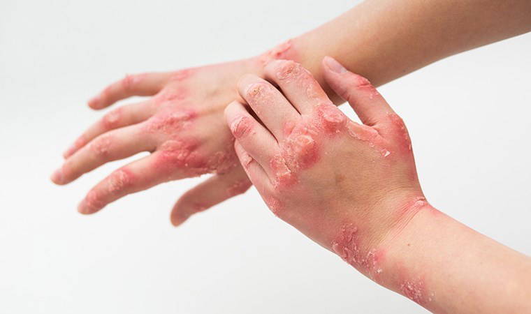 Uzmanı açıkladı: Egzaması olanlar yaz aylarında nelere dikkat etmeli?