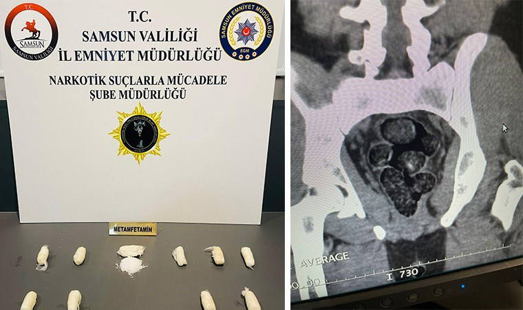 Midesinde uyuşturucu taşıyan kişi, havalimanında yakalandı