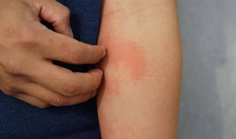 Kaşıntıdan nefes darlığına pek çok reaksiyona sebep oluyorlar: En alerjen 6 besin