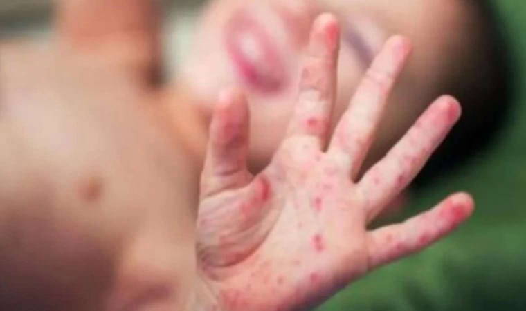 Kızamık vakalarında artış: Aşı olmayanlar risk altında!