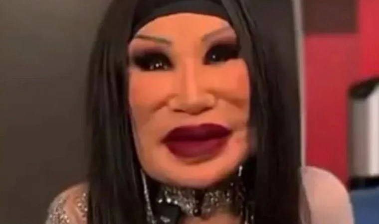 Ünlü oyuncu tanınmaz halde! Son hali korkuttu: Yüzüne 'yemeklik yağ' enjekte ettirdi