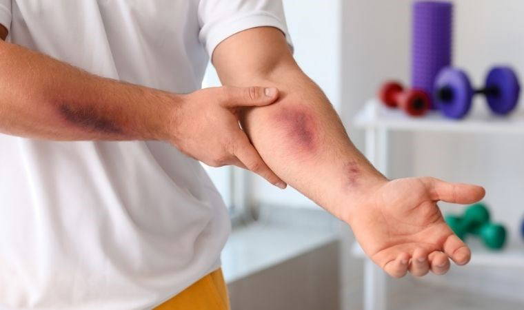 Vücudunuzda aniden oluşan morlukların sebepleri bunlarmış: Vücuttaki morarmalar neden olur, ani morlukların sebebi nedir? Morarmalara ne iyi gelir?