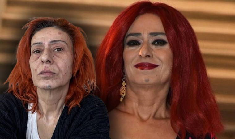 Yıldız Tilbe yüzünün nasıl yandığını anlattı: 'Uyudu' iddialarına yanıt verdi!