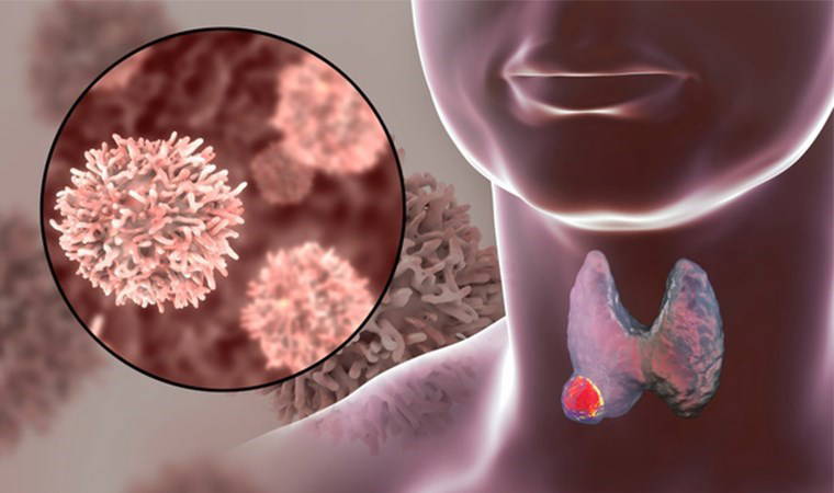 Uzmanından uyarı: 'Tiroid nodüllerinin ortalama yüzde 5’inde kanser gelişebiliyor'