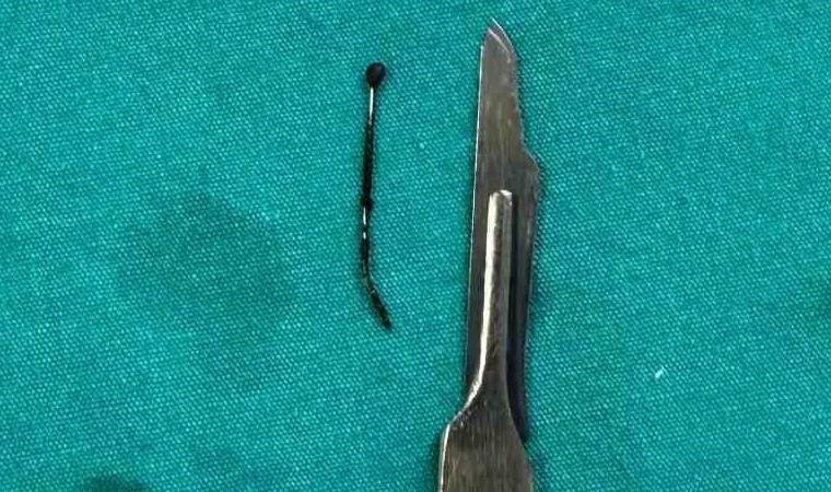 5 yaşındaki çocuğun 9 ay önce yuttuğu toplu iğne ameliyatla çıkarıldı